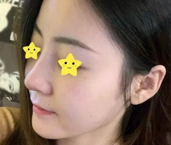 上海首爾麗格安建榮鼻綜合真人案例術(shù)后一個月左側(cè)