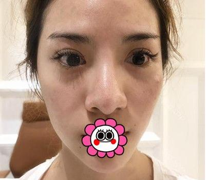 有“鼻王”之稱的楊群申做鼻子到底怎么樣？隆鼻前后圖片