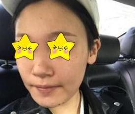 隆鼻真實(shí)案例，長(zhǎng)沙亞韓鄭京湘隆鼻前后對(duì)比圖片