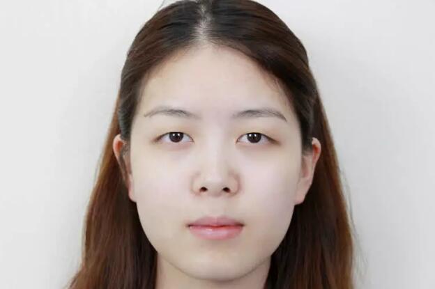 鄭州壹加壹王洛生全切雙眼皮案例術(shù)前 鄭州壹加壹王洛生全切雙眼皮案例術(shù)前