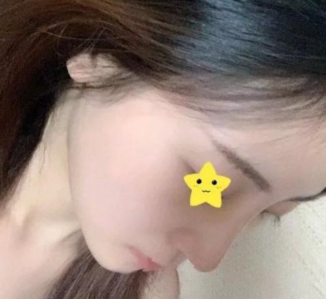 上海首爾麗格安建榮鼻綜合真人案例術(shù)后一個月右側(cè)