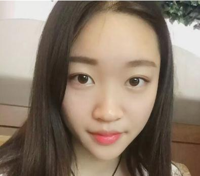 宜昌奧萊楊群申超體隆鼻案例分享，有圖