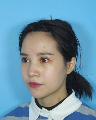 成都美立方(原華博)醫(yī)療美容醫(yī)院做眼部修復(fù)手術(shù)拆線后 成都美立方(原華博)醫(yī)療美容醫(yī)院做眼部修復(fù)手術(shù)拆線后