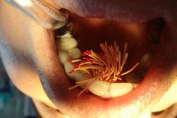 撫州英倫口腔根管治療怎么樣？根管治療有什么優(yōu)點(diǎn)？