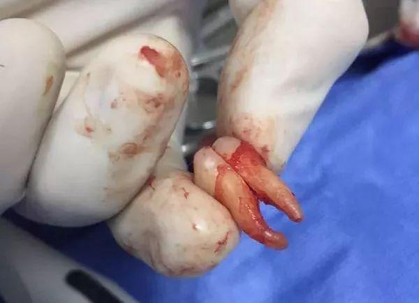 福州登特口腔拔智齒有哪些利弊？拔智齒有哪些情況？