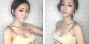 武漢米蘭醫(yī)療美容門診部做假體隆胸術(shù)后的第18天 武漢米蘭醫(yī)療美容門診部做假體隆胸術(shù)后的第18天