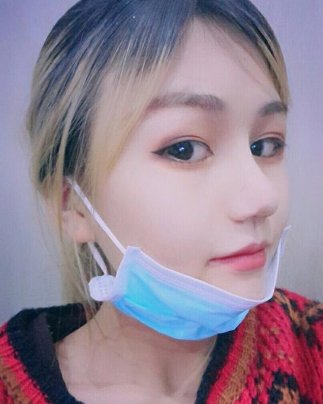 成都蜀尚蓉雅美容整形醫(yī)院做鼻綜合術(shù)后恢復(fù)好的情況