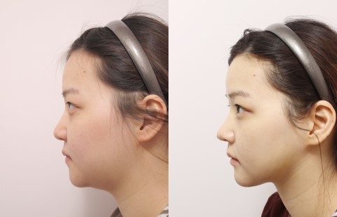 面部吸脂最好的辦法是什么？做一次面部吸脂多少錢(qián)？