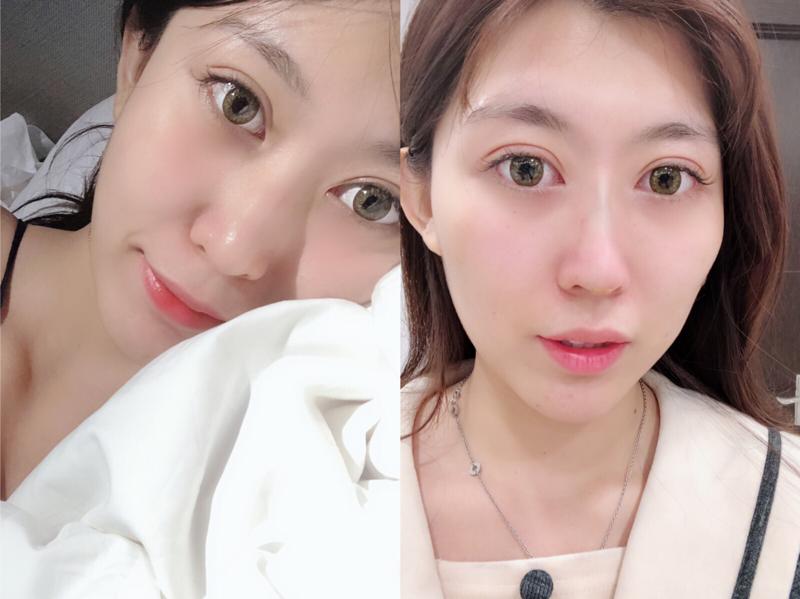 埋線手術(shù)鼻子的效果能保持多久？埋線手術(shù)鼻子術(shù)后的注意事項(xiàng)？