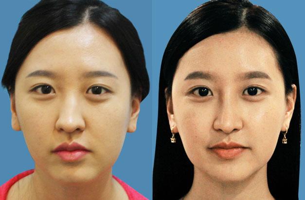 面部不對稱可以怎么矯正？臉一邊大一邊小怎么矯正？