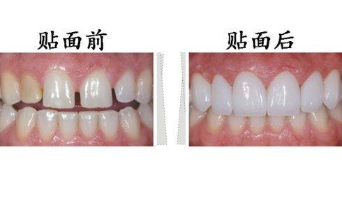 東莞拜博口腔瓷貼面有什么優(yōu)勢(shì)？瓷貼面有副作用嗎？