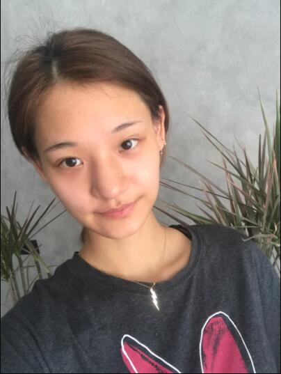 成都蜀尚蓉雅美容整形醫(yī)院做鼻綜合術(shù)前的鼻子