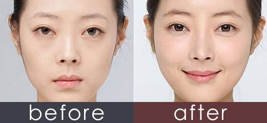 玻尿酸填充蘋(píng)果肌后效果能保持多久？想豐蘋(píng)果肌是自體好一點(diǎn)還是玻尿酸好一點(diǎn)？