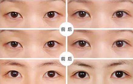 貴州旭美人整形埋線雙眼皮優(yōu)點有哪些如何選擇？