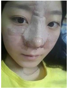 上海時光整形外科醫(yī)院做耳軟骨隆鼻術(shù)后剛剛結(jié)束