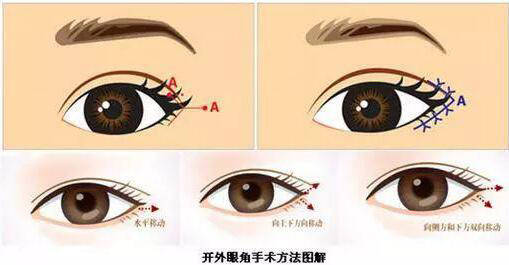 桂林嘉美醫(yī)療開外眼角是什么？開外眼角適用人群？