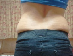 東莞華美醫(yī)療美容醫(yī)院做腰腹吸脂手術(shù)前的腰