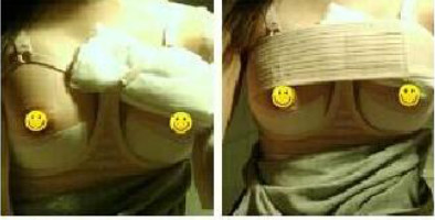 長沙愛思特醫(yī)療美容醫(yī)院做假體隆胸術(shù)后一個月 長沙愛思特醫(yī)療美容醫(yī)院做假體隆胸術(shù)后一個月