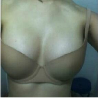 長(zhǎng)沙愛思特醫(yī)療美容醫(yī)院吳蒙做假體隆胸案例效果分享