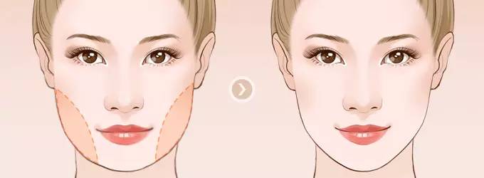 做下頜角整形手術(shù)效果好嗎？下頜角整形手術(shù)要多少錢？