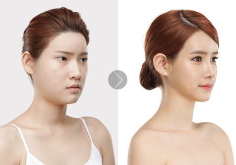 自體脂肪填充眉弓安全嗎？自體脂肪填充是永久的嗎？