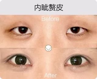 哈爾濱成美整形內(nèi)眥贅皮矯正怎么樣有哪幾種手術(shù)方法？