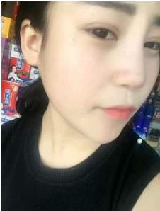 上海時光整形外科醫(yī)院做耳軟骨隆鼻術(shù)后自然的鼻子