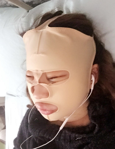 北京京民醫(yī)院（原釣魚臺(tái)醫(yī)院）整形外科做下頜骨手術(shù)后的恢復(fù)情況